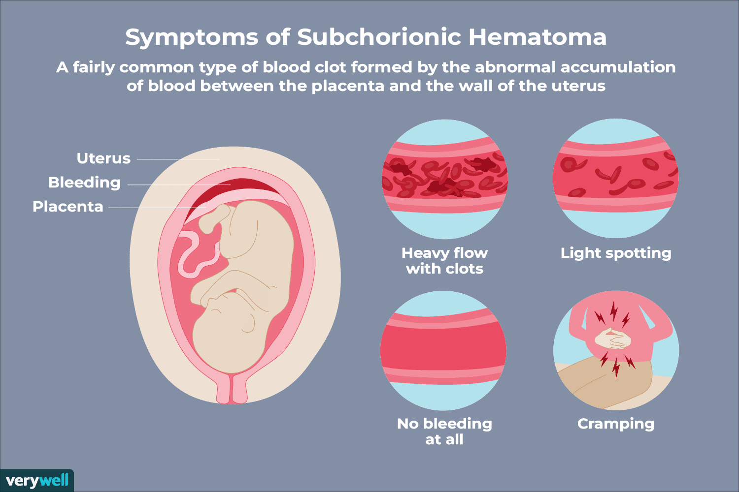 Sintomas de hematoma subcrônico